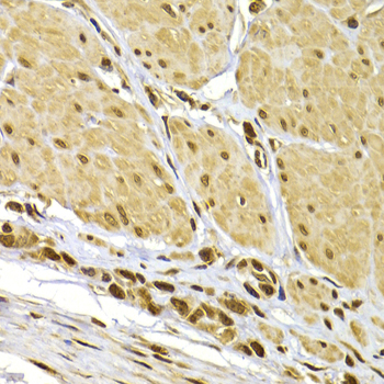 S100A4 / FSP1 Antibody - Immunohistochemistry of paraffin-embedded human gastric cancer using S100A4 antibodyat dilution of 1:100 (40x lens).