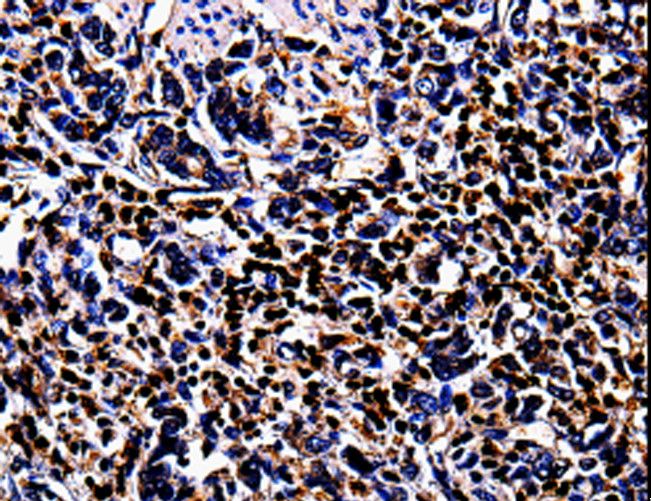 S100A4 / FSP1 Antibody - Immunohistochemistry of paraffin-embedded Human stomach cancer using S100A4 Polyclonal Antibody at dilution of 1:100.