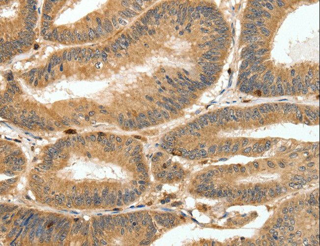 S100A4 / FSP1 Antibody - Immunohistochemistry of paraffin-embedded Human ovarian cancer using S100A4 Polyclonal Antibody at dilution of 1:80.