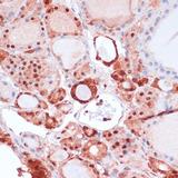 S100A5 Antibody - Immunohistochemistry of paraffin-embedded Human thyroid cancer using S100A5 Polyclonal Antibody at dilution of 1:100 (40x lens).