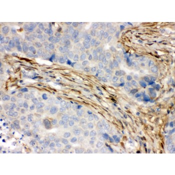 S100A6 / Calcyclin Antibody - S100 alpha 6 antibody IHC-paraffin. IHC(P): Human Mammary Cancer Tissue.
