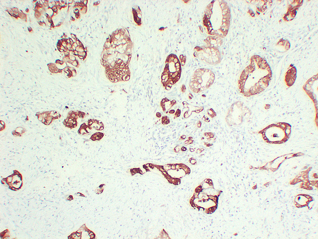 S100A6 / Calcyclin Antibody - Pancreatic Adenocarcinoma1