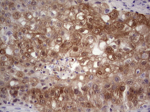 S100A6 / Calcyclin Antibody - Immunohistochemical staining of paraffin-embedded Carcinoma of Human lung tissue using anti-S100A6 mouse monoclonal antibody. (Heat-induced epitope retrieval by 1 mM EDTA in 10mM Tris, pH8.5, 120C for 3min,