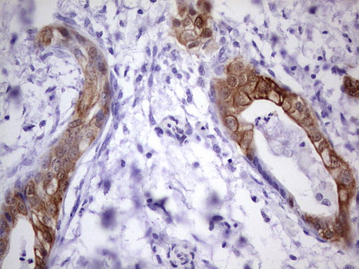 S100A6 / Calcyclin Antibody - Immunohistochemical staining of paraffin-embedded Carcinoma of Human pancreas tissue using anti-S100A6 mouse monoclonal antibody. (Heat-induced epitope retrieval by 1 mM EDTA in 10mM Tris, pH8.5, 120C for 3min,