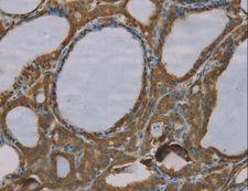 S100A6 / Calcyclin Antibody - Immunohistochemistry of paraffin-embedded Human esophagus cancer using S100A6 Polyclonal Antibody at dilution of 1:35.