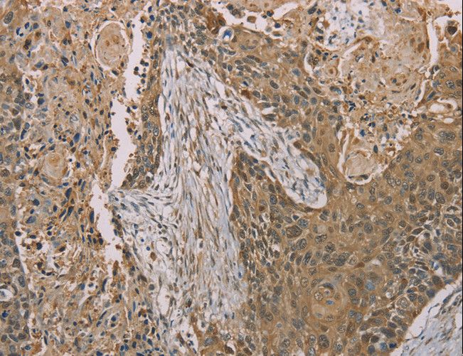 S100A6 / Calcyclin Antibody - Immunohistochemistry of paraffin-embedded Human esophagus cancer using S100A6 Polyclonal Antibody at dilution of 1:35.