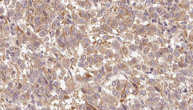 S100A7 / Psoriasin Antibody - 1:100 staining human Melanoma tissue by IHC-P. The sample was formaldehyde fixed and a heat mediated antigen retrieval step in citrate buffer was performed. The sample was then blocked and incubated with the antibody for 1.5 hours at 22°C. An HRP conjugated goat anti-rabbit antibody was used as the secondary.