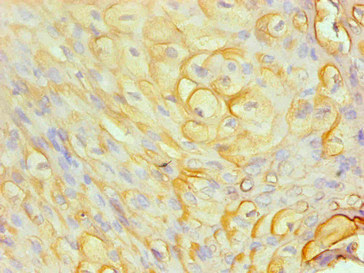 S100A8 / MRP8 Antibody - Immunohistochemical of paraffin-embedded human cervical cancer using S100A8 Monoclonal Antibody at dilution of 1:200