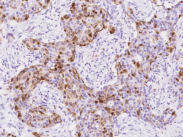 S100A8 / MRP8 Antibody - Immunochemical staining of human S100A8 in human breast carcinoma with rabbit monoclonal antibody at 1:2000 dilution, formalin-fixed paraffin embedded sections.