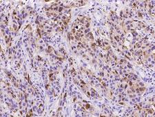 S100A8 / MRP8 Antibody - Immunochemical staining of human S100A8 in human breast carcinoma with rabbit monoclonal antibody at 1:20000 dilution, formalin-fixed paraffin embedded sections.