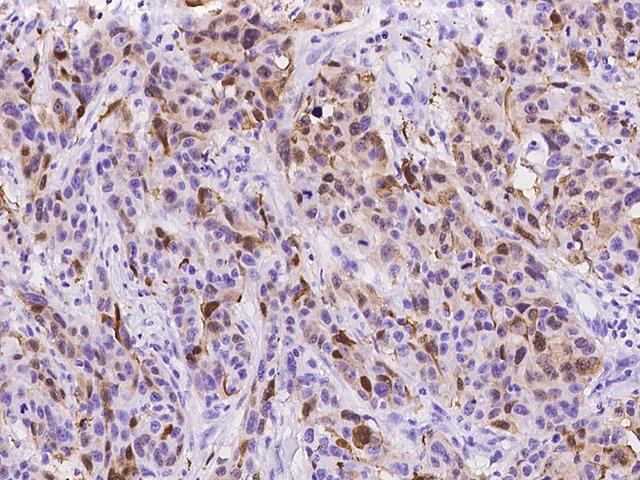 S100A8 / MRP8 Antibody - Immunochemical staining of human S100A8 in human breast carcinoma with rabbit monoclonal antibody at 1:20000 dilution, formalin-fixed paraffin embedded sections.