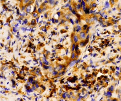 S100A8 / MRP8 Antibody - IHC of MRP8 pAb in paraffin-embedded human breast carcinoma tissue.