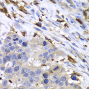 S100A8 / MRP8 Antibody - Immunohistochemistry of paraffin-embedded human esophageal cancer tissue.