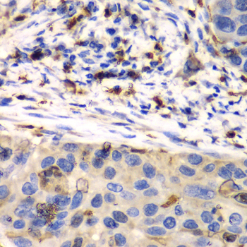 S100A8 / MRP8 Antibody - Immunohistochemistry of paraffin-embedded human esophageal cancer using S100A8 antibodyat dilution of 1:100 (40x lens).