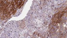 S100A8 / MRP8 Antibody - 1:100 staining human urothelial carcinoma tissue by IHC-P. The sample was formaldehyde fixed and a heat mediated antigen retrieval step in citrate buffer was performed. The sample was then blocked and incubated with the antibody for 1.5 hours at 22°C. An HRP conjugated goat anti-rabbit antibody was used as the secondary.