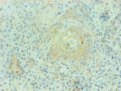 S100A9 / MRP14 Antibody - Immunohistochemical of paraffin-embedded human breast cancer using S100A9 Monoclonal Antibody at dilution of 1:200