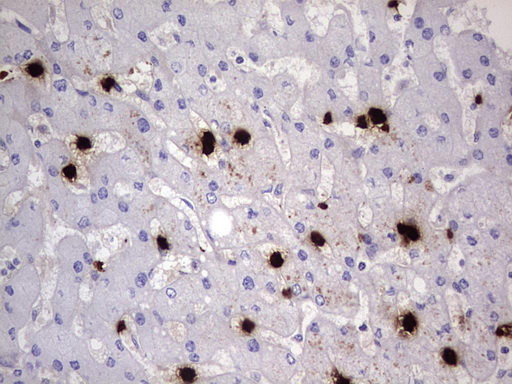 S100A9 / MRP14 Antibody - IHC of paraffin-embedded Human liver tissue using anti-S100A9 mouse monoclonal antibody. (Heat-induced epitope retrieval by 1 mM EDTA in 10mM Tris, pH8.5, 120°C for 3min).