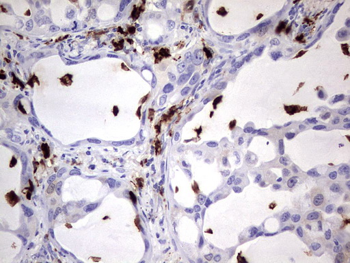 S100A9 / MRP14 Antibody - IHC of paraffin-embedded Carcinoma of Human lung tissue using anti-S100A9 mouse monoclonal antibody. (Heat-induced epitope retrieval by 1 mM EDTA in 10mM Tris, pH8.5, 120°C for 3min).