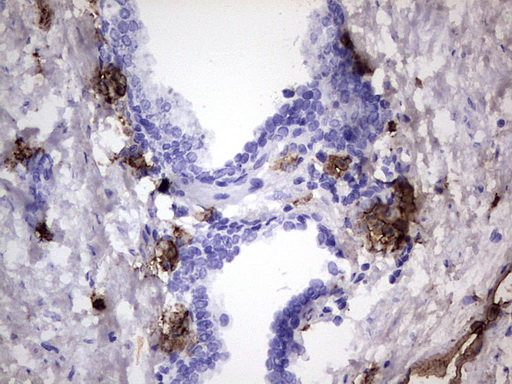 S100A9 / MRP14 Antibody - IHC of paraffin-embedded Carcinoma of Human prostate tissue using anti-S100A9 mouse monoclonal antibody. (Heat-induced epitope retrieval by 1 mM EDTA in 10mM Tris, pH8.5, 120°C for 3min).