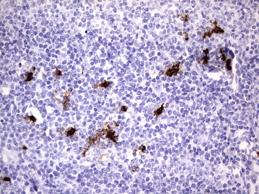 S100A9 / MRP14 Antibody - IHC of paraffin-embedded Human lymphoma tissue using anti-S100A9 mouse monoclonal antibody. (Heat-induced epitope retrieval by 1 mM EDTA in 10mM Tris, pH8.5, 120°C for 3min).