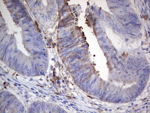 S100A9 / MRP14 Antibody - Immunohistochemical staining of paraffin-embedded Adenocarcinoma of Human colon tissue using anti-S100A9 mouse monoclonal antibody. (Heat-induced epitope retrieval by 1 mM EDTA in 10mM Tris, pH8.5, 120C for 3min,