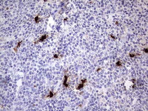 S100A9 / MRP14 Antibody - IHC of paraffin-embedded Human lymphoma tissue using anti-S100A9 mouse monoclonal antibody. (Heat-induced epitope retrieval by 1 mM EDTA in 10mM Tris, pH8.5, 120°C for 3min).