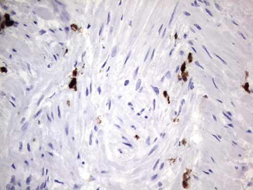 S100A9 / MRP14 Antibody - Immunohistochemical staining of paraffin-embedded Adenocarcinoma of Human ovary tissue using anti-S100A9 mouse monoclonal antibody. (Heat-induced epitope retrieval by 1 mM EDTA in 10mM Tris, pH8.5, 120C for 3min,