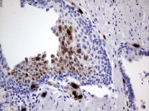 S100A9 / MRP14 Antibody - Immunohistochemical staining of paraffin-embedded Carcinoma of Human prostate tissue using anti-S100A9 mouse monoclonal antibody. (Heat-induced epitope retrieval by 1 mM EDTA in 10mM Tris, pH8.5, 120C for 3min,