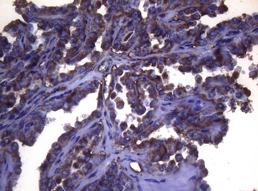 S100A9 / MRP14 Antibody - Immunohistochemical staining of paraffin-embedded Carcinoma of Human thyroid tissue using anti-S100A9 mouse monoclonal antibody. (Heat-induced epitope retrieval by 1mM EDTA in 10mM Tris buffer. (pH8.5) at 120°C for 3 min. (1:150)