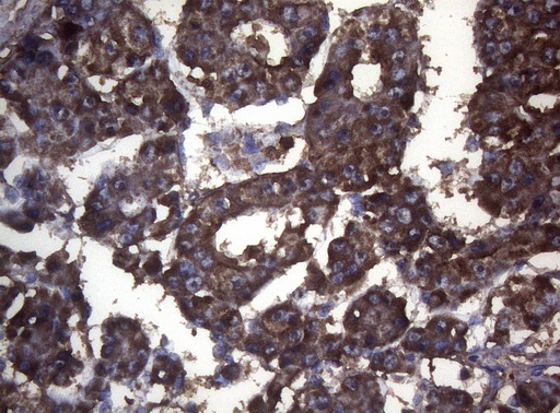 S100A9 / MRP14 Antibody - Immunohistochemical staining of paraffin-embedded Carcinoma of Human liver tissue using anti-S100A9 mouse monoclonal antibody. (Heat-induced epitope retrieval by 1mM EDTA in 10mM Tris buffer. (pH8.5) at 120°C for 3 min. (1:150)