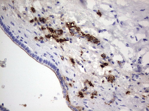 S100A9 / MRP14 Antibody - IHC of paraffin-embedded Carcinoma of Human pancreas tissue using anti-S100A9 mouse monoclonal antibody. (Heat-induced epitope retrieval by 1 mM EDTA in 10mM Tris, pH8.5, 120°C for 3min).