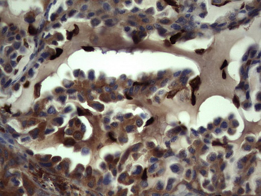 S100A9 / MRP14 Antibody - Immunohistochemical staining of paraffin-embedded Carcinoma of Human lung tissue using anti-S100A9 mouse monoclonal antibody. (Heat-induced epitope retrieval by 1 mM EDTA in 10mM Tris, pH8.5, 120C for 3min,