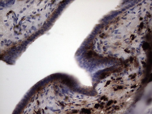S100A9 / MRP14 Antibody - Immunohistochemical staining of paraffin-embedded Carcinoma of Human pancreas tissue using anti-S100A9 mouse monoclonal antibody. (Heat-induced epitope retrieval by 1 mM EDTA in 10mM Tris, pH8.5, 120C for 3min,