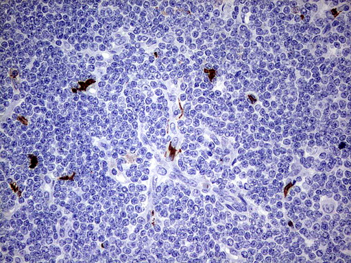 S100A9 / MRP14 Antibody - Immunohistochemical staining of paraffin-embedded Human lymphoma tissue using anti-S100A9 mouse monoclonal antibody.  heat-induced epitope retrieval by 1 mM EDTA in 10mM Tris, pH8.0, 120C for 3min)