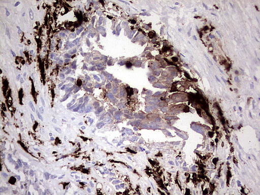 S100A9 / MRP14 Antibody - Immunohistochemical staining of paraffin-embedded Human testicular cancer tissue using anti-S100A9 mouse monoclonal antibody.  heat-induced epitope retrieval by 1 mM EDTA in 10mM Tris, pH8.0, 120C for 3min)
