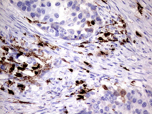 S100A9 / MRP14 Antibody - Immunohistochemical staining of paraffin-embedded Carcinoma of Human kidney tissue using anti-S100A9 mouse monoclonal antibody.  heat-induced epitope retrieval by 1 mM EDTA in 10mM Tris, pH8.0, 120C for 3min)