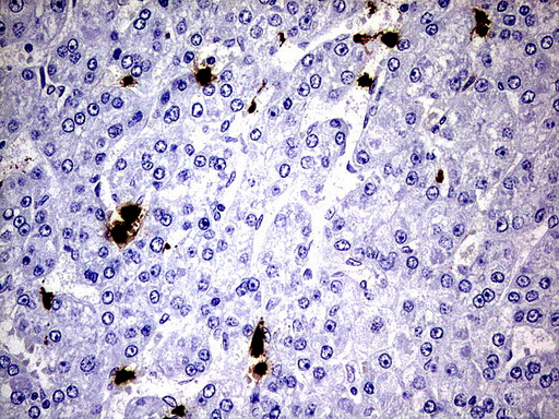 S100A9 / MRP14 Antibody - Immunohistochemical staining of paraffin-embedded Carcinoma of Human liver tissue using anti-S100A9 mouse monoclonal antibody.  heat-induced epitope retrieval by 1 mM EDTA in 10mM Tris, pH8.0, 120C for 3min)