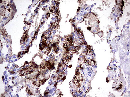 S100A9 / MRP14 Antibody - Immunohistochemical staining of paraffin-embedded Human lung tissue using anti-S100A9 mouse monoclonal antibody.  heat-induced epitope retrieval by 1 mM EDTA in 10mM Tris, pH8.0, 120C for 3min)