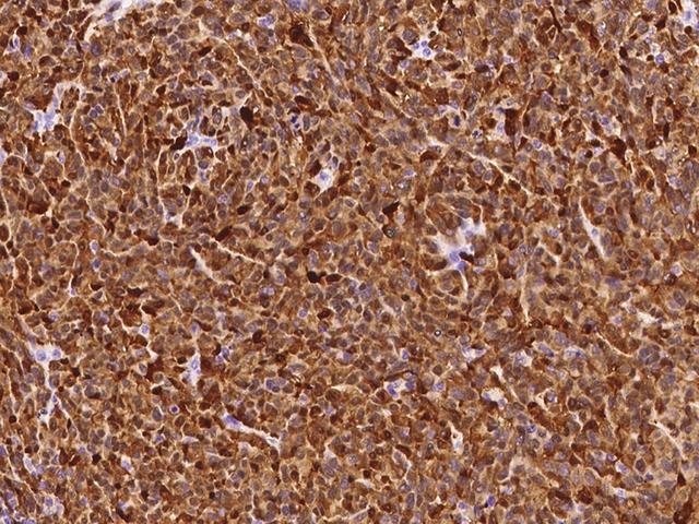 S100B / S100 Beta Antibody - Immunochemical staining of human S100B in human malignant melanoma with rabbit monoclonal antibody at 1:500 dilution, formalin-fixed paraffin embedded sections.
