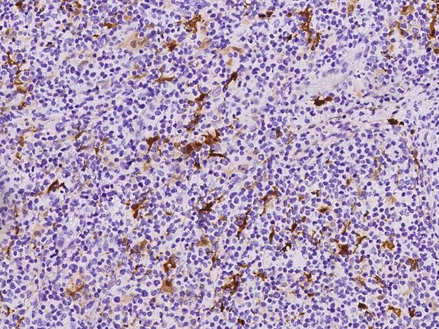 S100B / S100 Beta Antibody - Immunochemical staining of human S100B in human lymphoma with rabbit monoclonal antibody at 1:10000 dilution, formalin-fixed paraffin embedded sections.