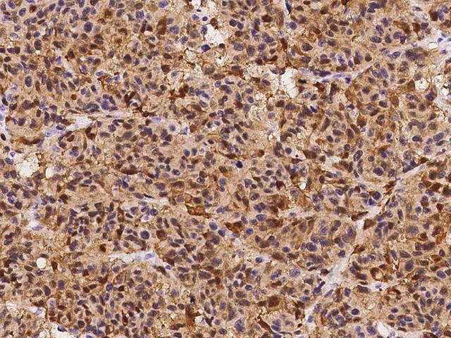 S100B / S100 Beta Antibody - Immunochemical staining of human S100B in human malignant melanoma with rabbit monoclonal antibody at 1:10000 dilution, formalin-fixed paraffin embedded sections.