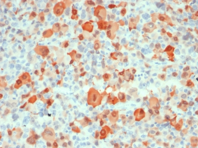 S100B / S100 Beta Antibody - Formalin-fixed, paraffin-embedded human Melanoma stained with Purified S100B Mouse Recombinant Monoclonal Antibody (rS100B/1012).