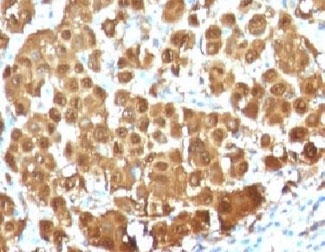 S100B / S100 Beta Antibody - IHC testing of FFPE human melanoma with S100 beta antibody (clone S100B/1012). Required HIER: boil tissue sections in 10mM citrate buffer, pH 6, for 10-20 min followed by cooling at RT for 20 min.