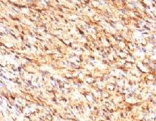 S100B / S100 Beta Antibody - IHC testing of FFPE human schwanoma with S100 beta antibody (clone S100B/1012). Required HIER: boil tissue sections in 10mM citrate buffer, pH 6, for 10-20 min followed by cooling at RT for 20 min.