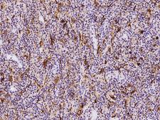 S100B / S100 Beta Antibody - Immunochemical staining of human S100B in human lymphoma with rabbit polyclonal antibody at 1:1000 dilution, formalin-fixed paraffin embedded sections.