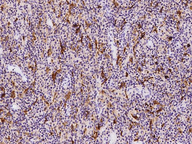 S100B / S100 Beta Antibody - Immunochemical staining of human S100B in human lymphoma with rabbit polyclonal antibody at 1:1000 dilution, formalin-fixed paraffin embedded sections.