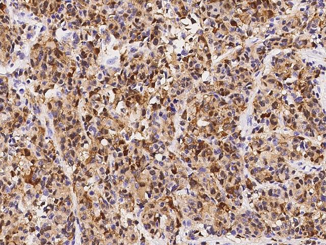 S100B / S100 Beta Antibody - Immunochemical staining of human S100B in human malignant melanoma with rabbit polyclonal antibody at 1:1000 dilution, formalin-fixed paraffin embedded sections.