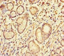 S100G / CABP9K Antibody - Immunohistochemistry of paraffin-embedded human gastric cancer at dilution of 1:100