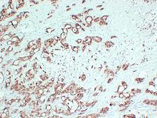 S100P Antibody - Pancreatic Carcinoma 1