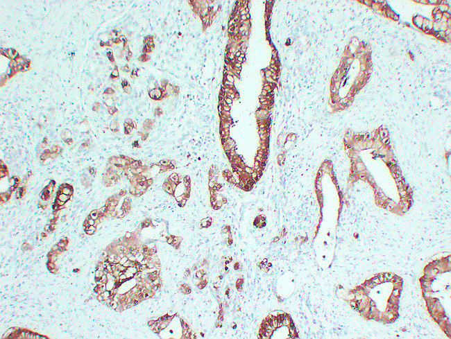 S100P Antibody - Pancreatic Carcinoma 2